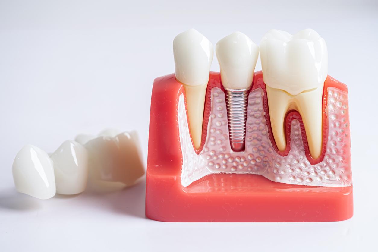 Dental implant model