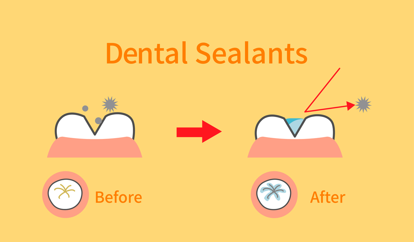 Dental sealants
